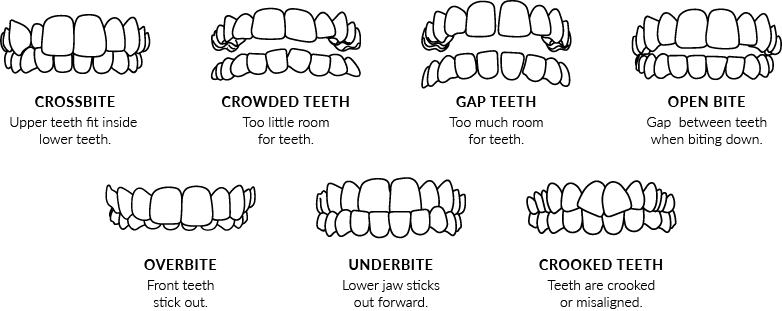 Invisalign Treatable Cases | Tweed Dental Centre